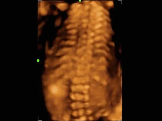 Клинические изображения УЗИ аппарат Mindray Z60 портативный