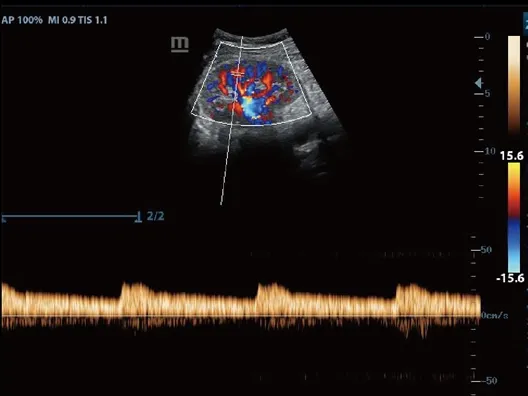 Клинические изображения УЗИ аппарат Mindray Z60 портативный