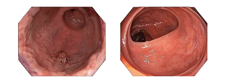 Esophagogastroduodenoscopy-with-Olympus-GIF-HQ190-and-Colonoscopy-with-Olympus-CF-HQ190LI.png Esophagogastroduodenoscopy-with-Olympus-GIF-HQ190-and-Colonoscopy-with-Olympus-CF-HQ190LI.png